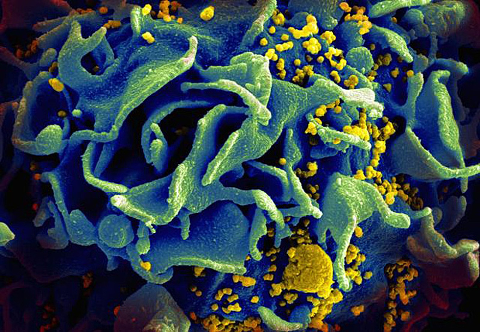 Estudo aponta resultados ‘encorajadores’ de vacina experimental contra HIV